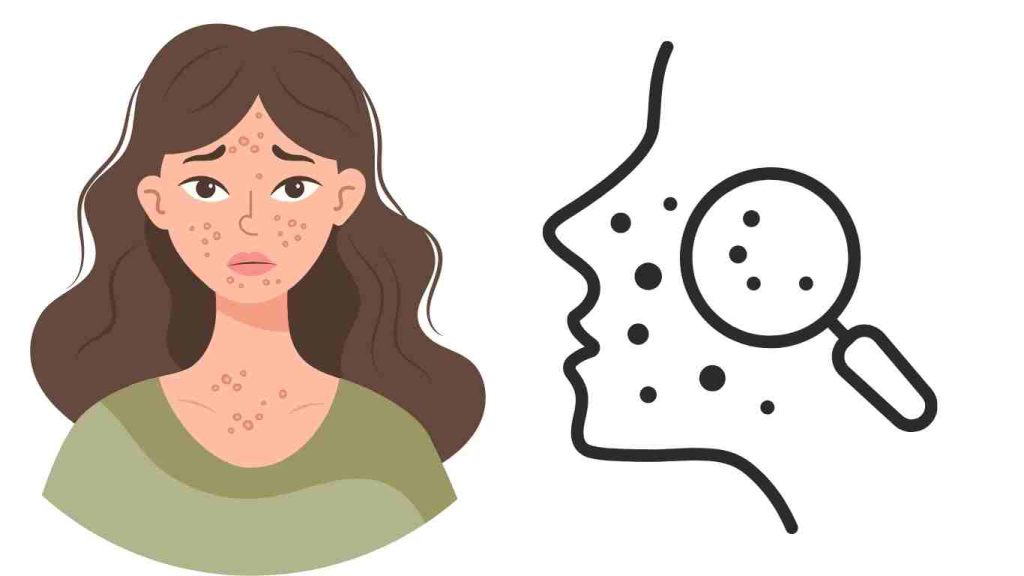 How to Remove Pimples Naturally at Home: 10 Easy & Effective Remedies