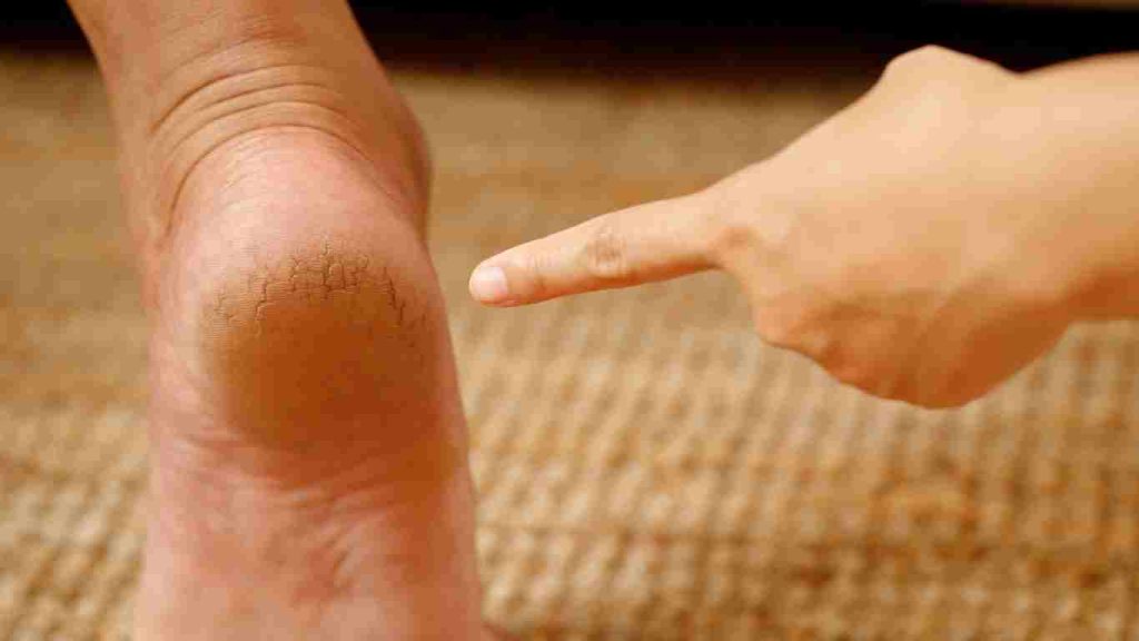 Ways to Heal Cracked Heels Naturally and Effectively